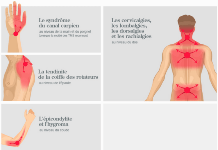 Syndrome du canal carpien vs tendinite